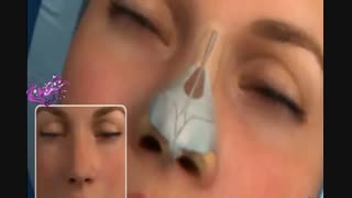 رینوپلاستی ( عمل زیبایی بینی)
