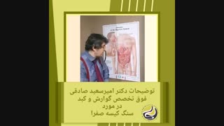سنگ کیسه صفرا