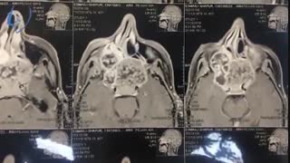 جراحی تومور قاعده جمجمه