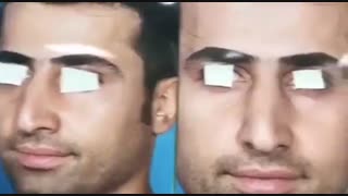 قبل از جراحی بینی