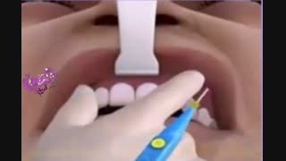 پروتز گونه یا کاشت گونه