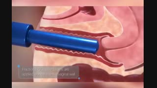 لیزر واژینال