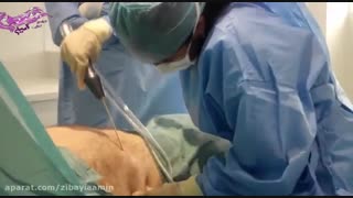 عمل لیپوماتیک در مشهد