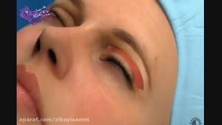انیمیشن جراحی زیبایی پلک بالا