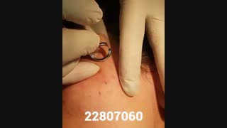 برداشت خال - کلینیک زیبایی پری سیما - 22807060