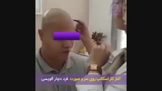 شروع کار بر روی سر و صورت فرد دچار آلوپسی
