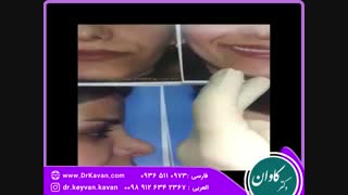 جراحی زیبایی بینی