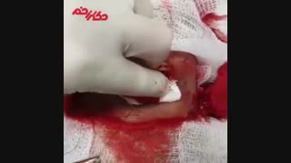 جراحی زخم پای دیابتی توسط تیم فوق تخصصی دکتر زخم