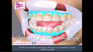 بلیچینگ دندان