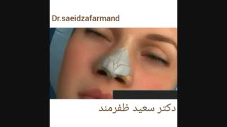 جراحی بینی گوشتی