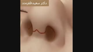 فیلم جراحی قوز بینی