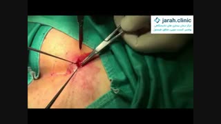 هترین روش  درمان بواسیر (درمان هموروئید) با لیزر را درکلینیک نوین