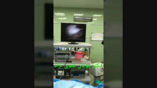 آرتروسکوپی ترمیم پارگی منیسک دسته سطلی زانو