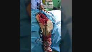 جا اندازی در رفتگی قدیمی آرنج