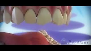 کامپوزیت ونیر در بهترین نقطه تهران – کلینیک  دندانپزشکی تاج