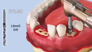 ایمپلنت (implant) در بهترین نقطه تهران – کلینیک  دندانپزشکی تاج
