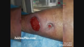 درمان زخم شریانی| کلینیک زخم پلاس
