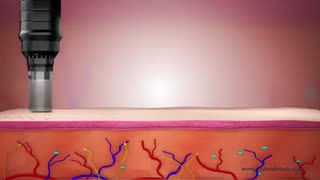 نگاهی به عملکرد درماپن، میکرونیدلینگ و درمارولر