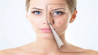 علل بروز و درمان آکنه و جوش چیست؟ پاسخ پزشک متخصص