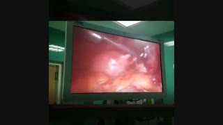 جراحی لاپاراسکوپی خارج از رحمی