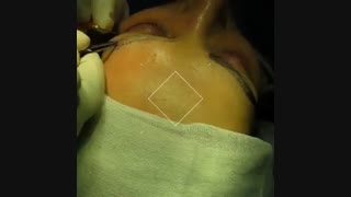 کاشت ابرو طبیعی