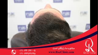 کاشت مو | فیلم کاشت مو | کلینیک پوست و مو رز | شماره 22