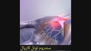 سندروم تونل کارپال