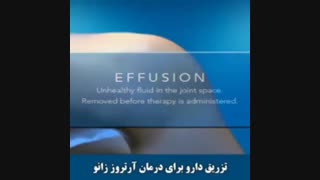 درمان آرتروز زانو