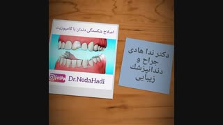 اصلاح شکستگی دندان با کامپوزیت