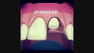 ایمپلنت دندان