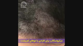 حل مشکل کم پشتی مو با میکرواسکالپ