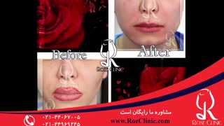 تزریق چربی | فیلم تزریق چربی | کلینیک پوست و مو رز | شماره20