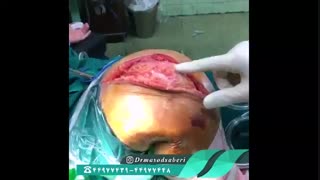 مزایای تعویض مفصل زانو