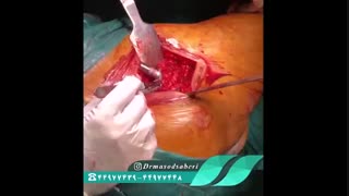 نحوه کارگذاری پروتز هیپ(مفصل مصنوعی لگن) با سیمان ارتوپدی