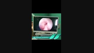 نتیجه بازسازی رباط صلیبی به روش آرتروسکوپی