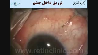 فیلم تزریق در چشم