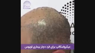حل مشکل ریزش مو بیماری لوپوس