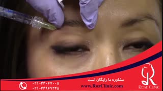 تزریق بوتاکس | فیلم تزریق بوتاکس | کلینیک پوست و مو رز12