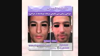 نمونه کار جراحی بینی استخوانی