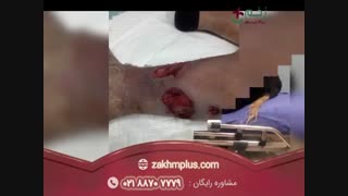 روند درمان زخم شریانی |کلینیک زخم پلاس