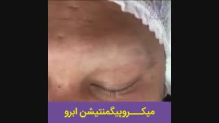 میکرو ابرو برای افراد آلوپسی