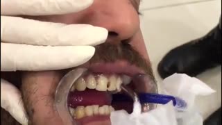 زیبایی 4 واحد ونیر کامپوزیت|کلینیک دندانپزشکی مدرن