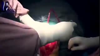 تعویض مفصل زانو