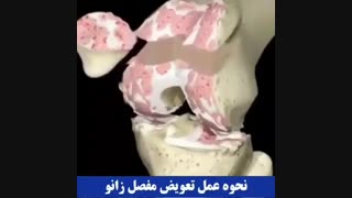 تعویض مفصل زانو