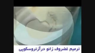 عمل آرتروسکوپی زانو