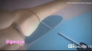 عمل جراحی زانو ضربدری