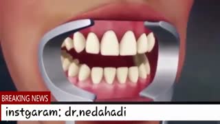بلیچینگ یا سفید کردن دندان | دکتر ندا هادی دندانپزشک زیبایی و ترمیمی ارتودنسی