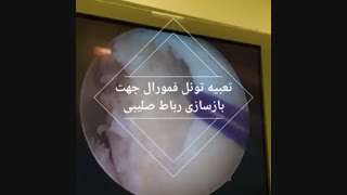 عمل بازسازی رباط صلیبی و همچنین منیسک داخلی