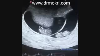 سونوگرافی بارداری دو قلو