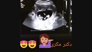سونوگرافی چند قلویی